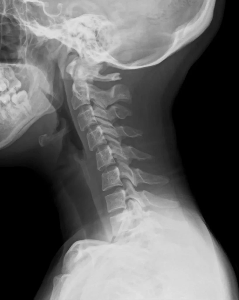 肩こりを有する患者のあ頚椎レントゲン写真